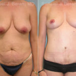 Mommy Makeover Before and After Photos in Montvale, NJ, Patient 12914