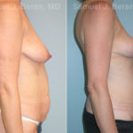 Mommy Makeover Before and After Photos in Montvale, NJ, Patient 12914