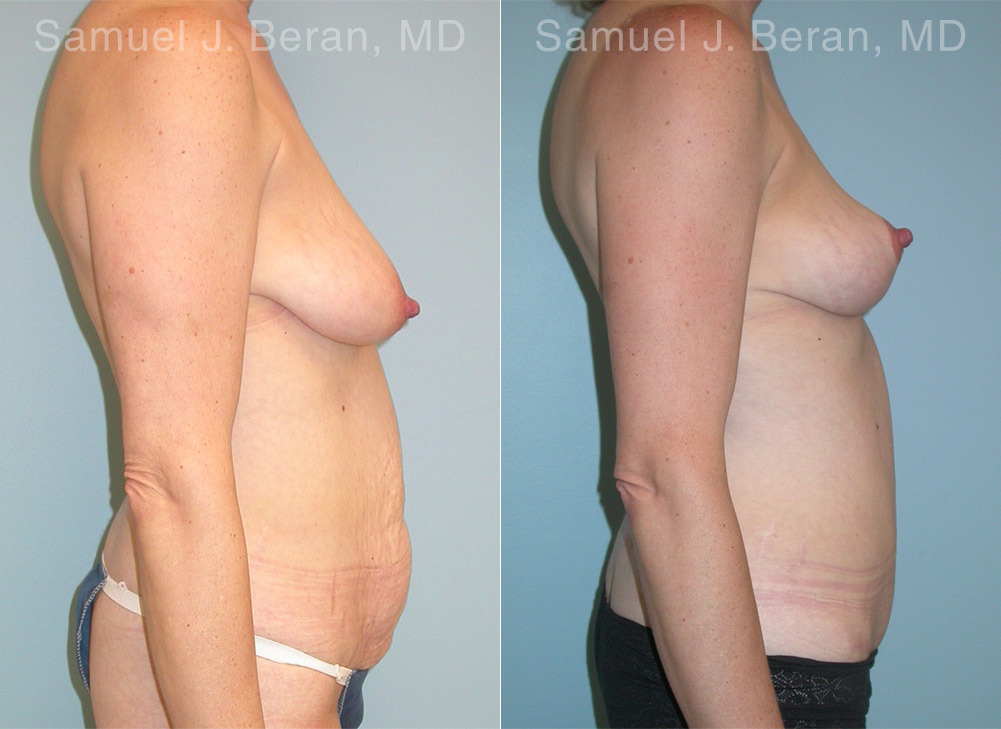 Mommy Makeover Before and After Photos in Montvale, NJ, Patient 12914