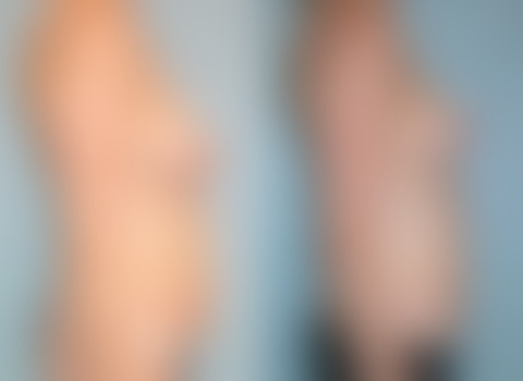 Mommy Makeover Before and After Photos in Montvale, NJ, Patient 12914