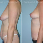 Mommy Makeover Before and After Photos in Montvale, NJ, Patient 12914