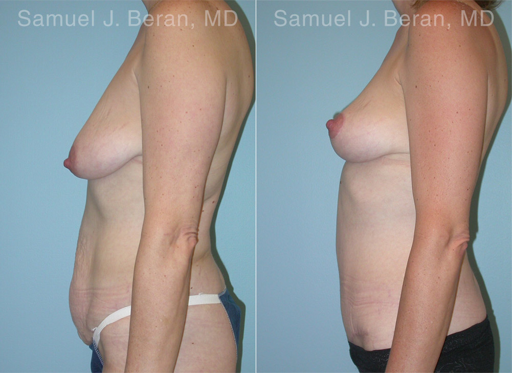 Mommy Makeover Before and After Photos in Montvale, NJ, Patient 12914