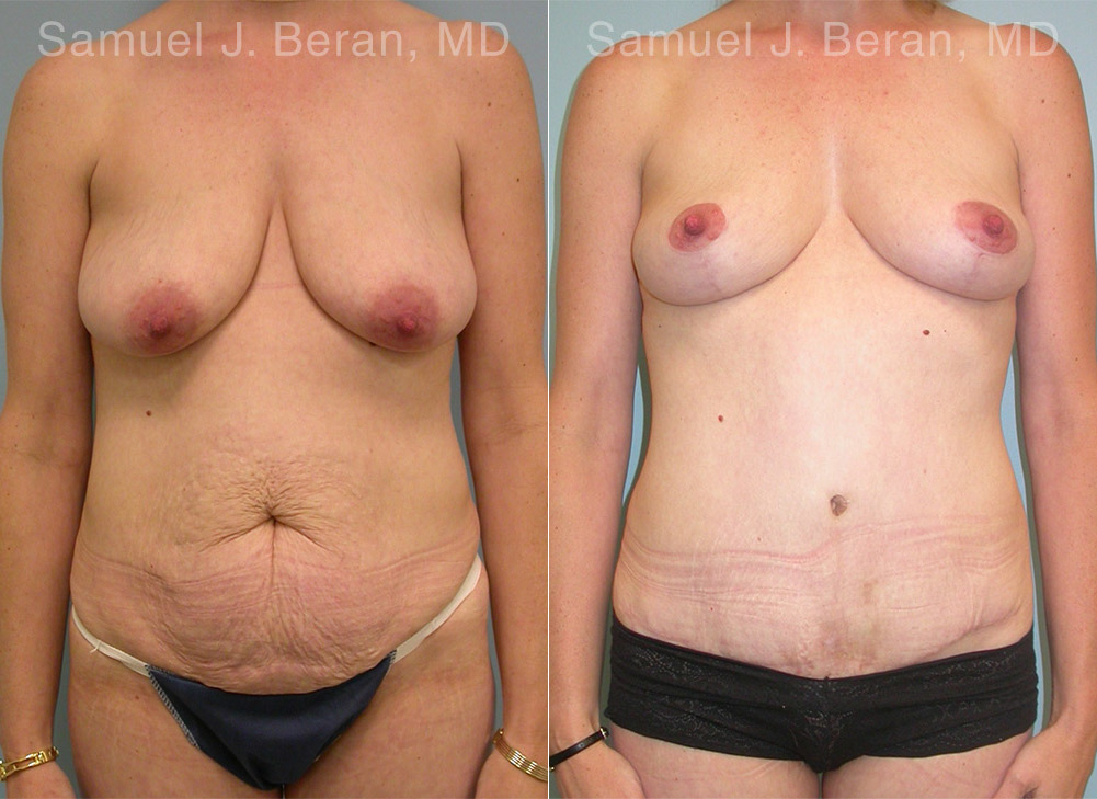 Mommy Makeover Before and After Photos in Montvale, NJ, Patient 12914
