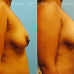 Mommy Makeover Before and After Photos in Montvale, NJ, Patient 12921
