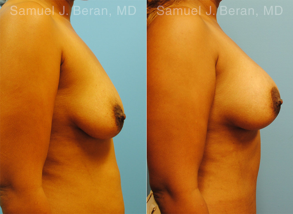 Mommy Makeover Before and After Photos in Montvale, NJ, Patient 12921