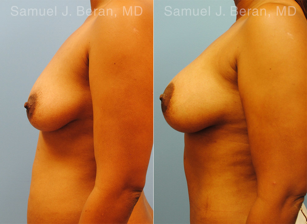 Mommy Makeover Before and After Photos in Montvale, NJ, Patient 12921