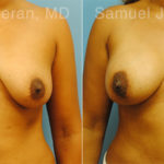 Mommy Makeover Before and After Photos in Montvale, NJ, Patient 12921