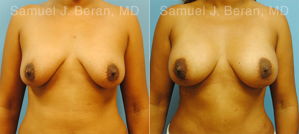 Mommy Makeover Before and After Photos in Montvale, NJ, Patient 12921