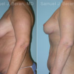 Mommy Makeover Before and After Photos in Montvale, NJ, Patient 12928