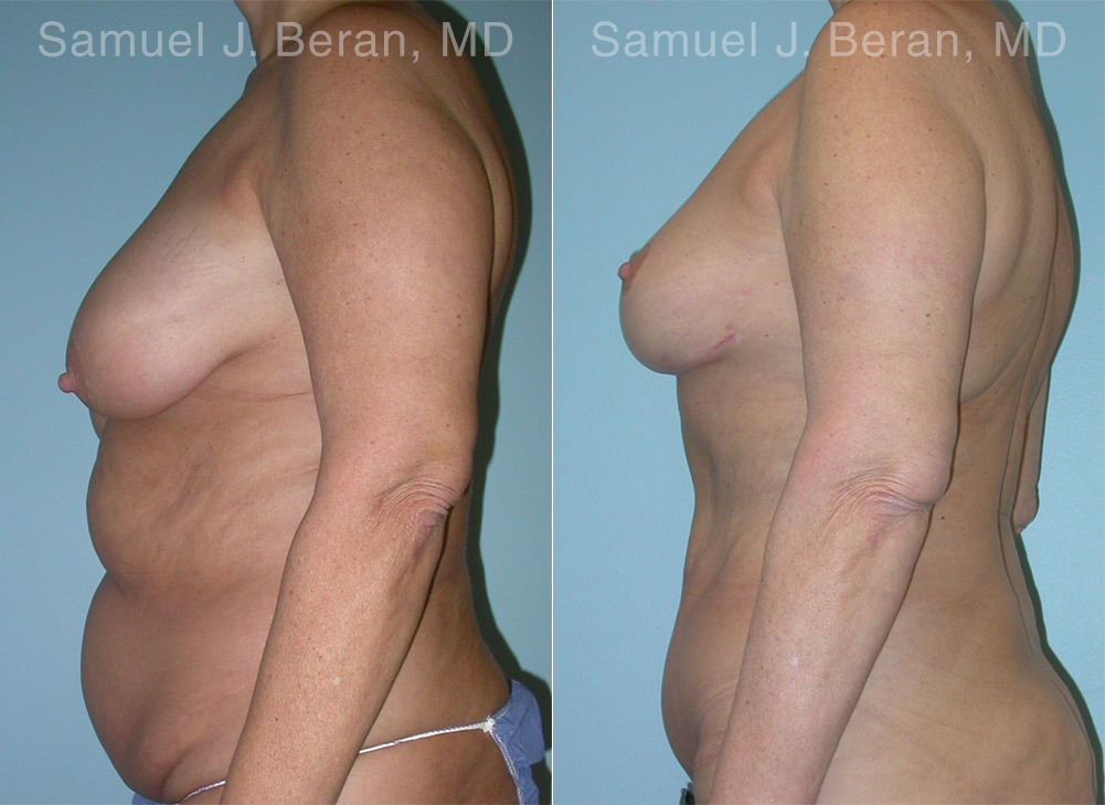 Mommy Makeover Before and After Photos in Montvale, NJ, Patient 12928