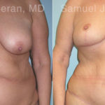 Mommy Makeover Before and After Photos in Montvale, NJ, Patient 12928