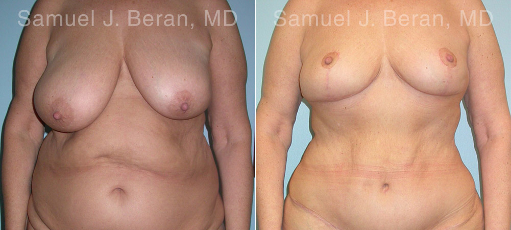 Mommy Makeover Before and After Photos in Montvale, NJ, Patient 12928