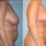 Mommy Makeover Before and After Photos in Montvale, NJ, Patient 12928