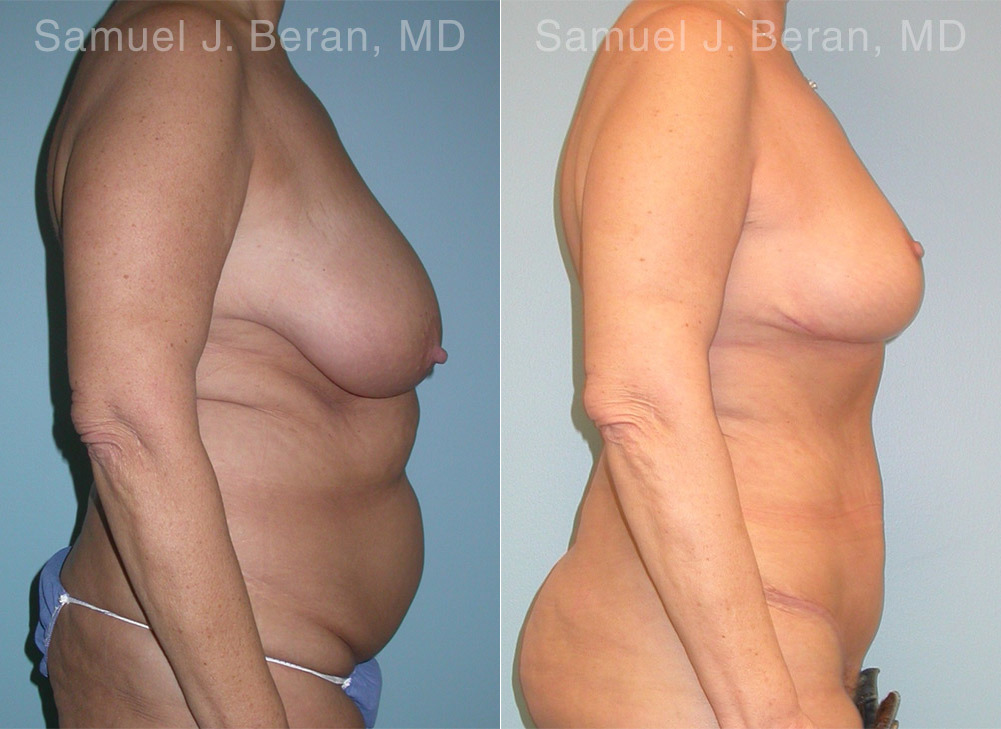 Mommy Makeover Before and After Photos in Montvale, NJ, Patient 12928