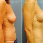 Mommy Makeover Before and After Photos in Montvale, NJ, Patient 12935