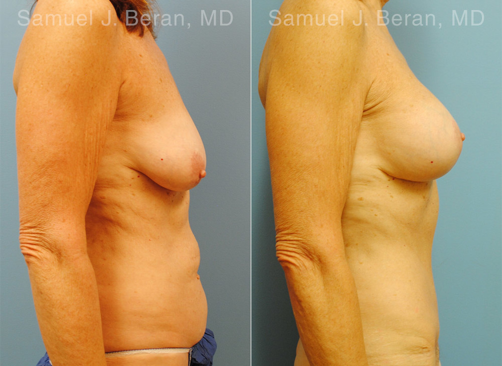Mommy Makeover Before and After Photos in Montvale, NJ, Patient 12935