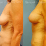 Mommy Makeover Before and After Photos in Montvale, NJ, Patient 12935