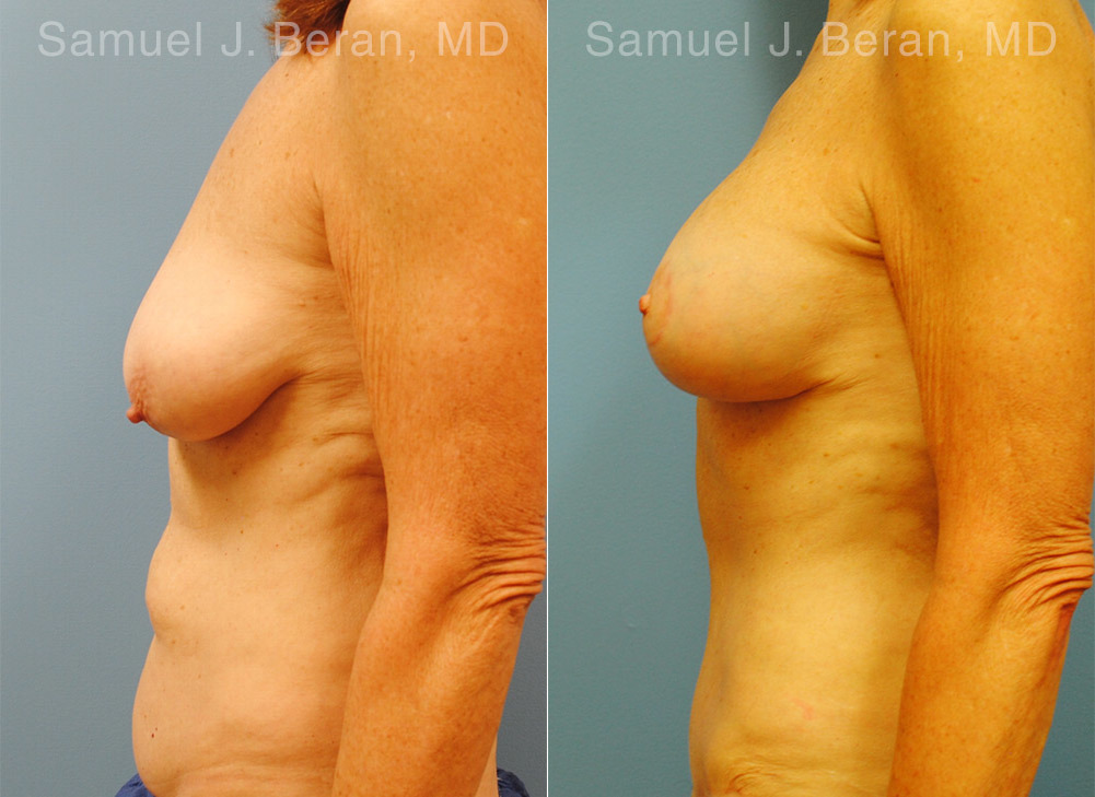 Mommy Makeover Before and After Photos in Montvale, NJ, Patient 12935