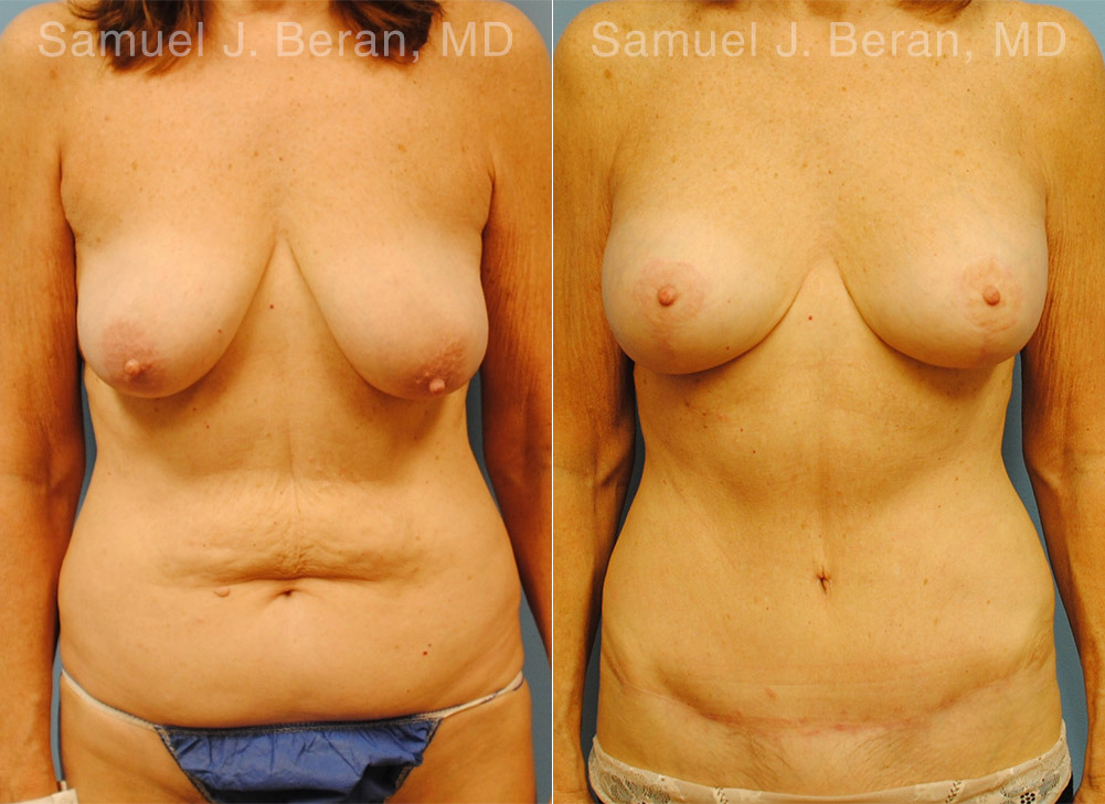 Mommy Makeover Before and After Photos in Montvale, NJ, Patient 12935
