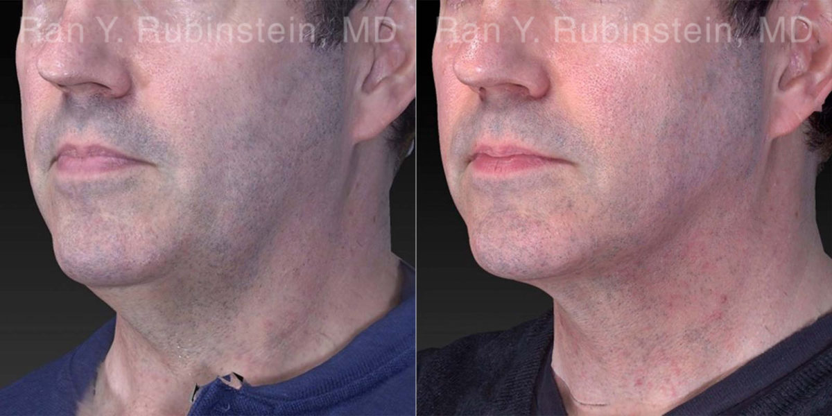 Laser Lift Precision Tx Before and After Photos in Montvale, NJ, Patient 21040
