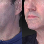 Laser Lift Precision Tx Before and After Photos in Montvale, NJ, Patient 21040