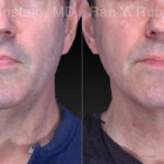 Laser Lift Precision Tx Before and After Photos in Montvale, NJ, Patient 21040