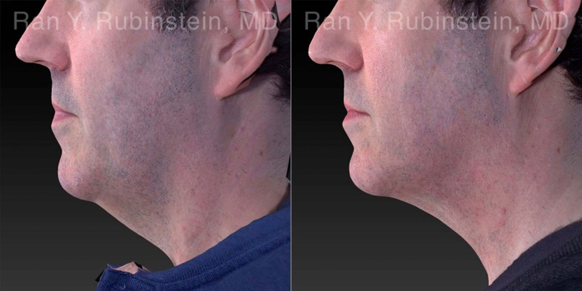 Laser Lift Precision Tx Before and After Photos in Montvale, NJ, Patient 21040