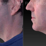 Laser Lift Precision Tx Before and After Photos in Montvale, NJ, Patient 21040