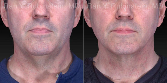 Laser Lift Precision Tx Before and After Photos in Montvale, NJ, Patient 21040