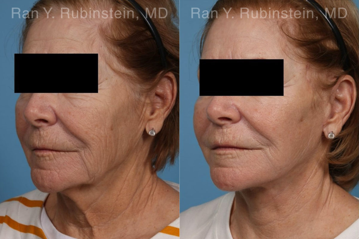 Face lift & Neck lift Before and After Photos in Montvale, NJ, Patient 21942