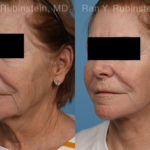 Face lift & Neck lift Before and After Photos in Montvale, NJ, Patient 21942