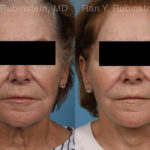 Face lift & Neck lift Before and After Photos in Montvale, NJ, Patient 21942