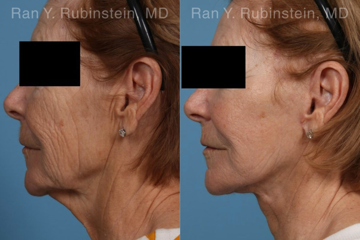 Face lift & Neck lift Before and After Photos in Montvale, NJ, Patient 21942