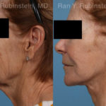 Face lift & Neck lift Before and After Photos in Montvale, NJ, Patient 21942