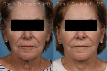 Face lift & Neck lift Before and After Photos in Montvale, NJ, Patient 21942