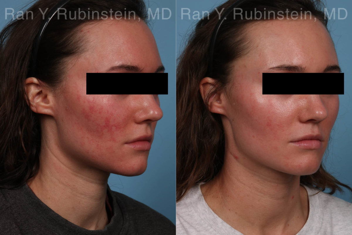 Laser Treatments Before and After Photos in Montvale, NJ, Patient 21994