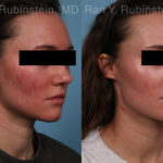 Laser Treatments Before and After Photos in Montvale, NJ, Patient 21994