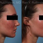 Laser Treatments Before and After Photos in Montvale, NJ, Patient 21994