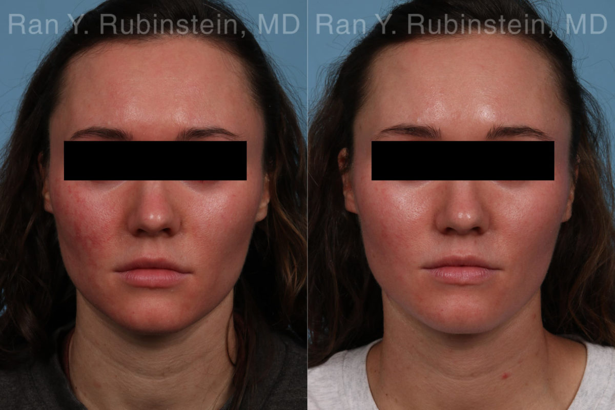 Laser Treatments Before and After Photos in Montvale, NJ, Patient 21994