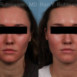 Laser Treatments Before and After Photos in Montvale, NJ, Patient 21994