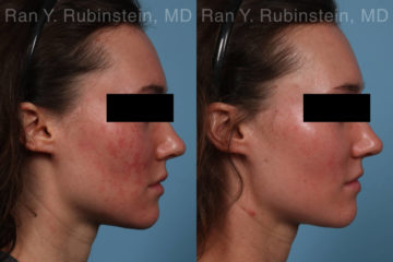 Laser Treatments Before and After Photos in Montvale, NJ, Patient 21994