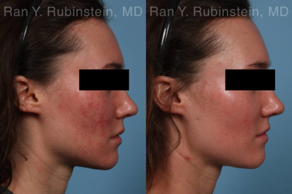Laser Treatments Before and After Photos in Montvale, NJ, Patient 21994