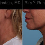 Laser Lift Precision Tx Before and After Photos in Montvale, NJ, Patient 22127