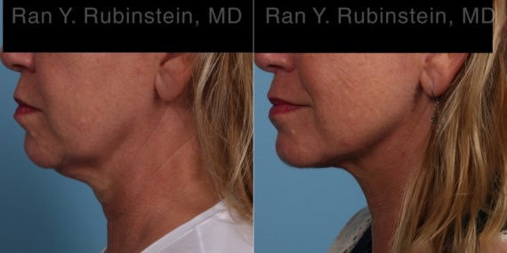 Laser Lift Precision Tx Before and After Photos in Montvale, NJ, Patient 22127