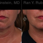 Laser Lift Precision Tx Before and After Photos in Montvale, NJ, Patient 22127