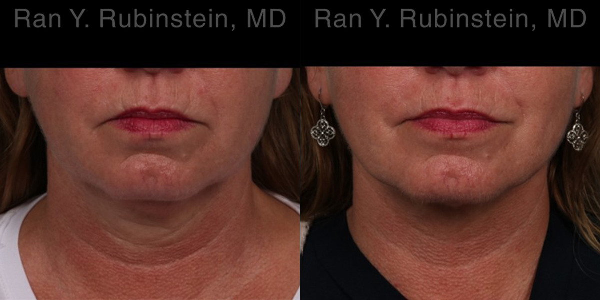 Laser Lift Precision Tx Before and After Photos in Montvale, NJ, Patient 22127