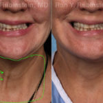 Laser Treatments Before and After Photos in Montvale, NJ, Patient 22149