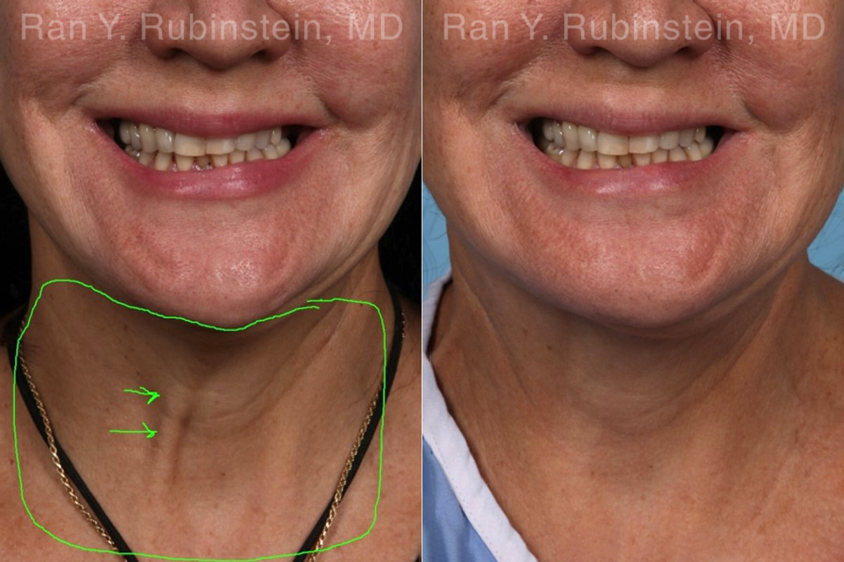 Laser Treatments Before and After Photos in Montvale, NJ, Patient 22149