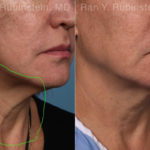Laser Treatments Before and After Photos in Montvale, NJ, Patient 22149