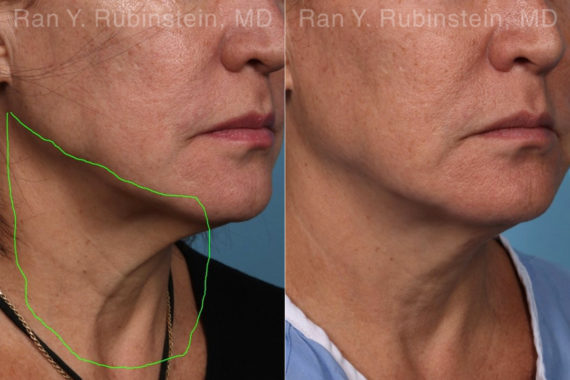 Laser Treatments Before and After Photos in Montvale, NJ, Patient 22149